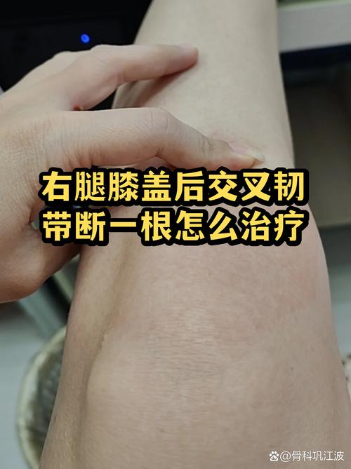 PCL出现时，如何快速诊断和处理？